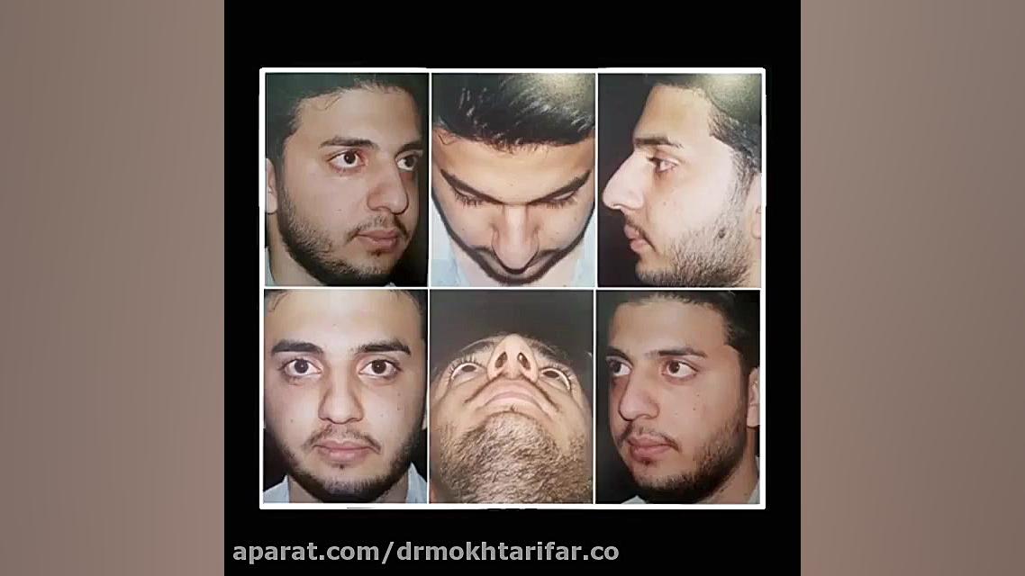 فیلم نمونه کار جراحی بینی بعد از یک ماه - جراحی بینی در لرستان دکتر فاطمه مختاری فر جراح بینی در لرستان
