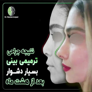 نتیجه جراحی ترمیمی بینی بسیار...