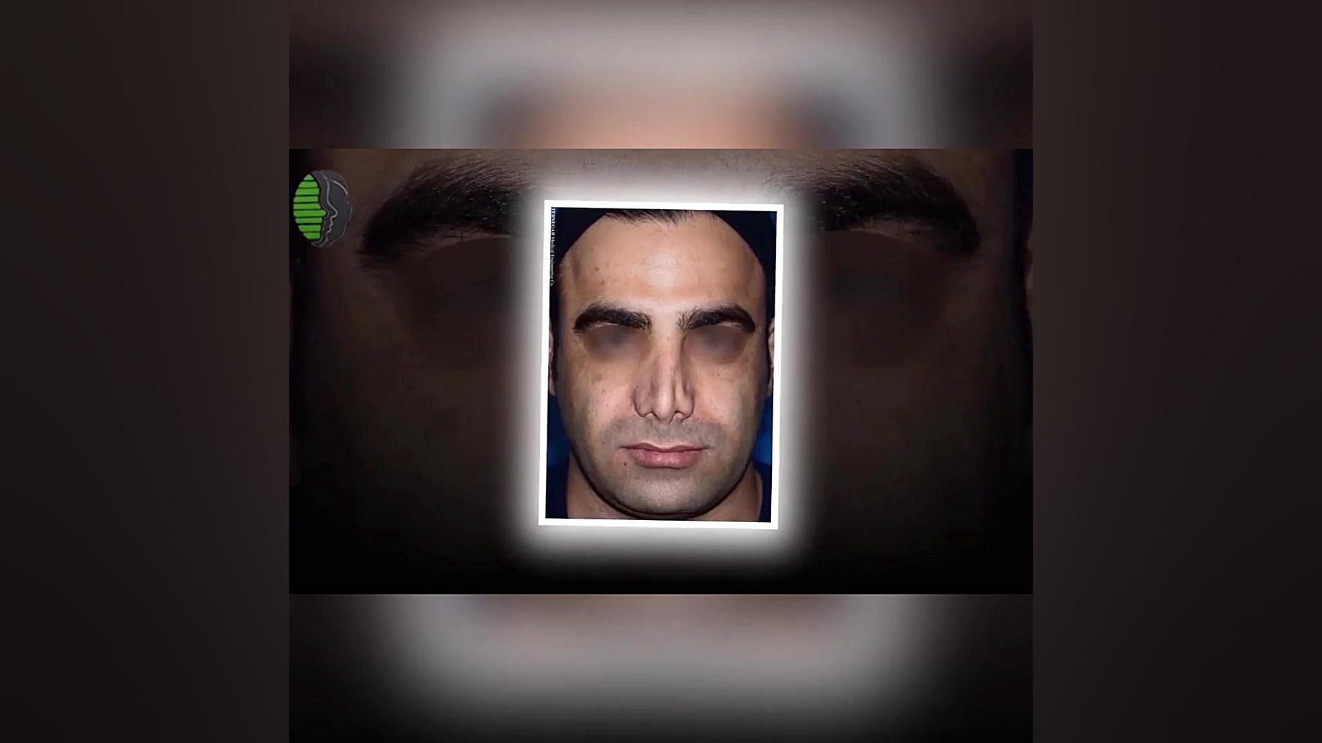 جراحی بینی ترمیمی با سابقه دو بار جراحی بینی ناموفق | دکتر باستانی نژاد برداشتن خال