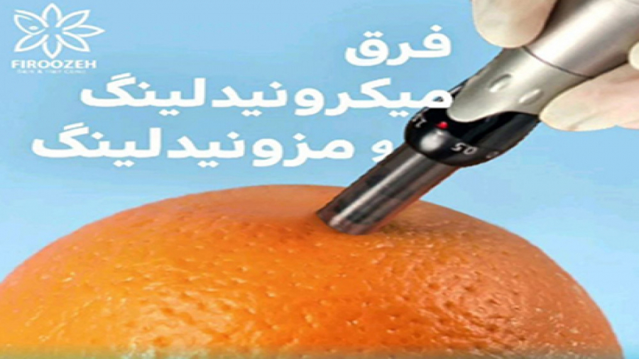 فرق میکرونیدلینگ و مزونیدلینگ پلاسماجت