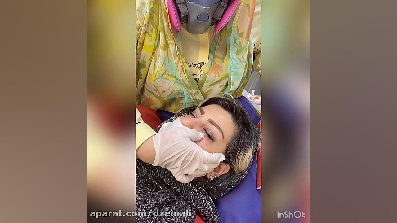 تزریق فیلر بسبار با کیفیت الیاکسین اس ار ساخت سوئیس برای پر کردن گودی زیرچشم دکتر فرحناز زینعلی - متخصص پوست، مو، زیبایی زنجان