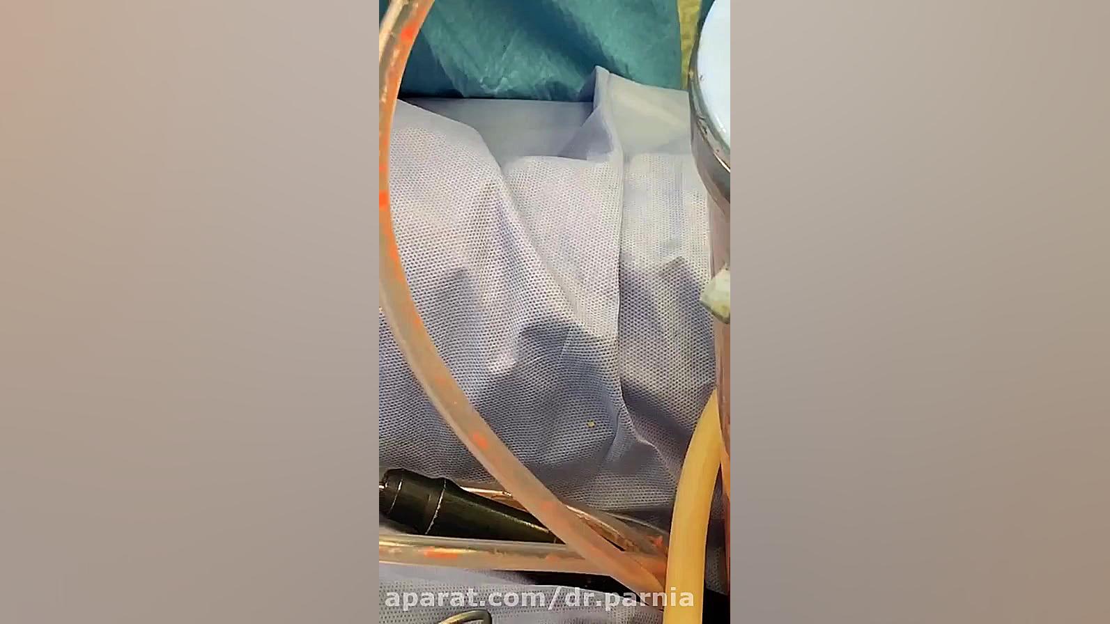 فیلم ابدومینوپلاستی و ماستوپکسی دکتر رفیع پرنیا فوق تخصص پلاستیک