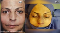 عمل زیبایی بینی با انحراف شدید توسط دکتر امید ابراهیمی بهترین جراح بینی در تهران دکتر امید ابراهیمی
