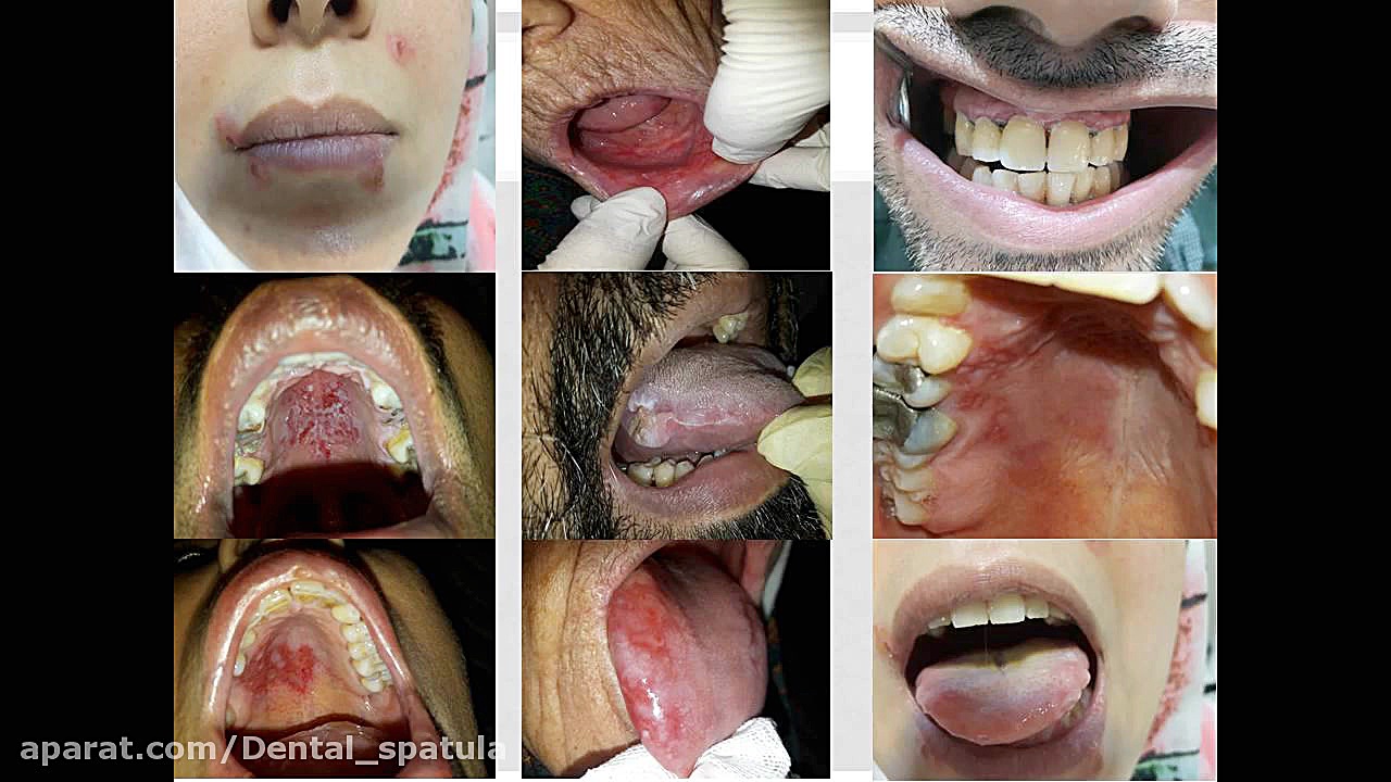ضایعات وزیکولوبولوز و اولسراتیو قسمت اول هشتگ خرسی