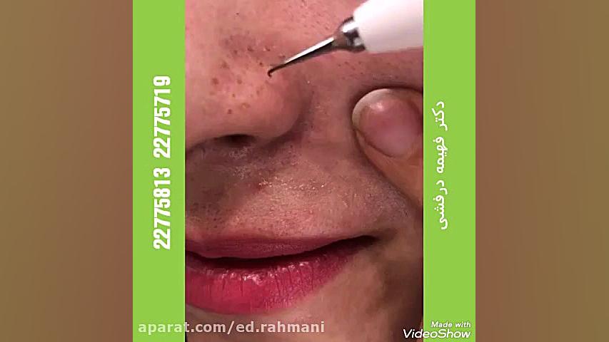 پلاسما اولتراسوند پرتابل جیبی