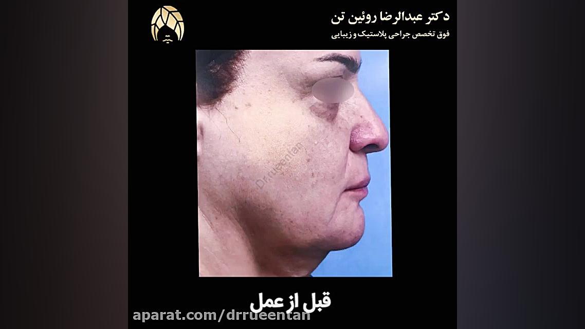 جراحی لیفت میانی صورت با اندوتاین در خانم 60 ساله دکتر عبدالرضا روئین تن