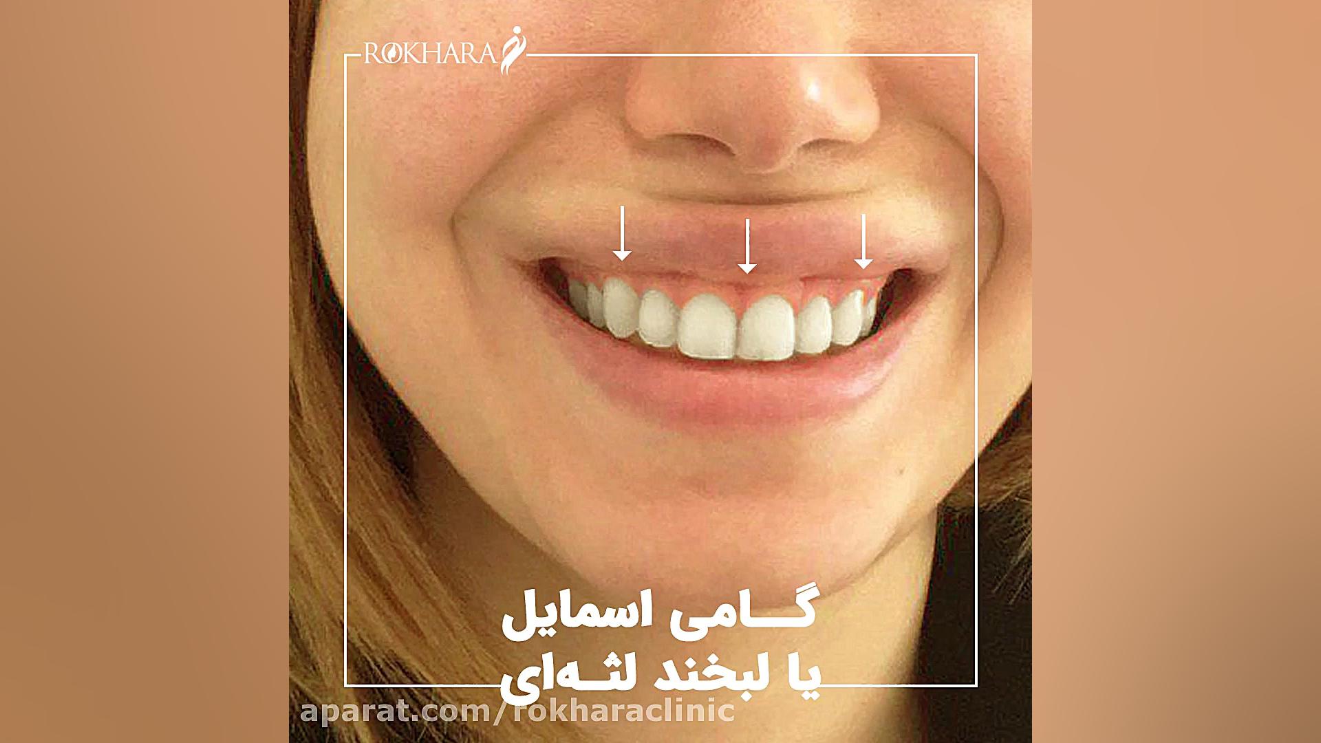 لبخند لثه ای بیماری سندروم نوتان