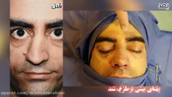 جراحی کجی شدید بینی توسط دکتر امید ابراهیمی بهترین جراح بینی در تهران دکتر امید ابراهیمی