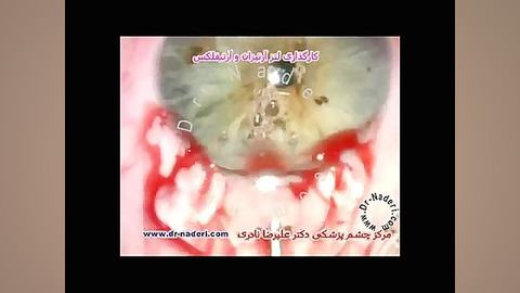 جراحی لنز آرتیزان- مرکزچشم پزشکی دکتر علیرضا نادری مرکز چشم پزشکی دکتر علیرضا نادری www.dr-naderi.com
