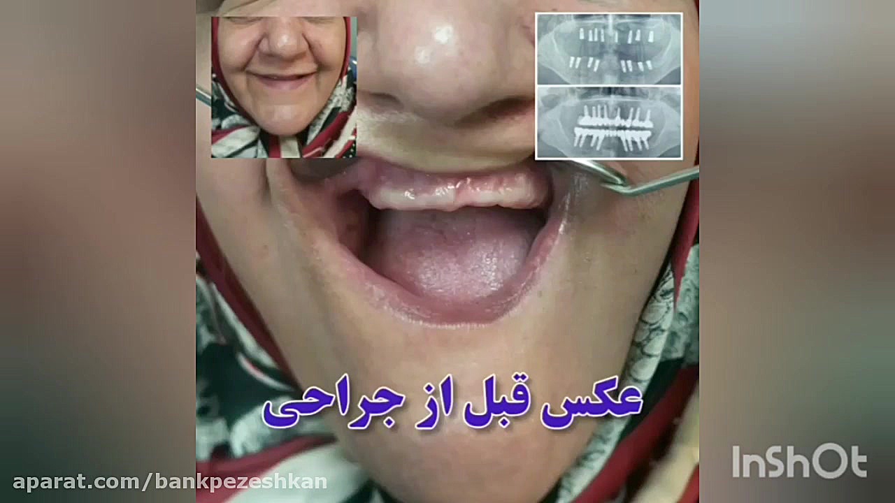 مرکز تخصصی جراحی فک و صورت دکتر مهدی حسینیان روکش دندان