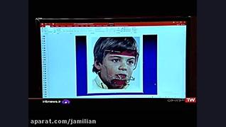 درمان ناهنجاری فک با ارتودنسی / متخصص ارتودنسی / دکتر جمیلیان دکتر عبدالرضا جمیلیان - متخصص ارتودنسی