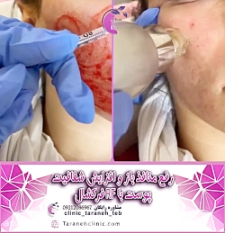 آراف فرکشنال و مزونیدلینگ صورت