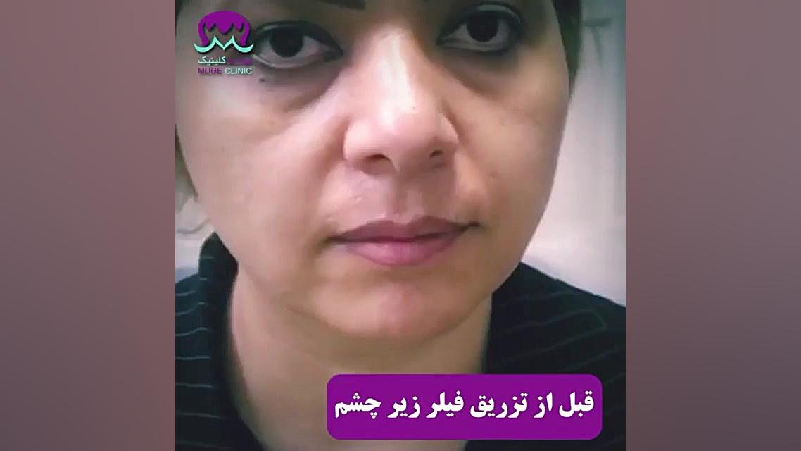 تزریق ژل زیر چشم-موگه کلینیک ماموپلاستی