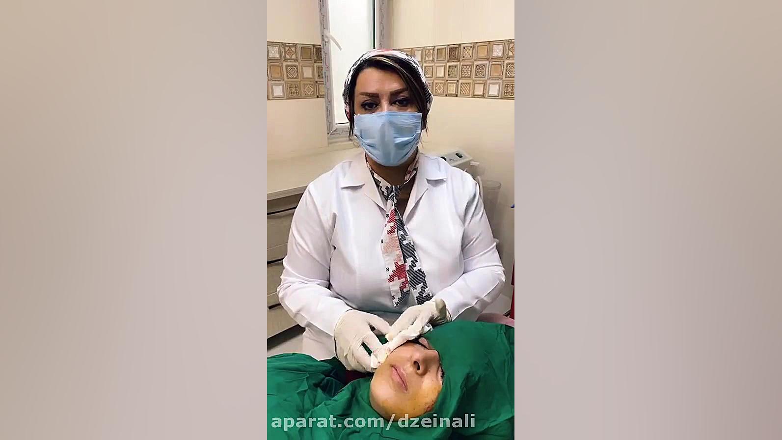 ساب سیژن اسکار آکنه (جای جوش) دکتر فرحناز زینعلی - متخصص پوست، مو، زیبایی زنجان