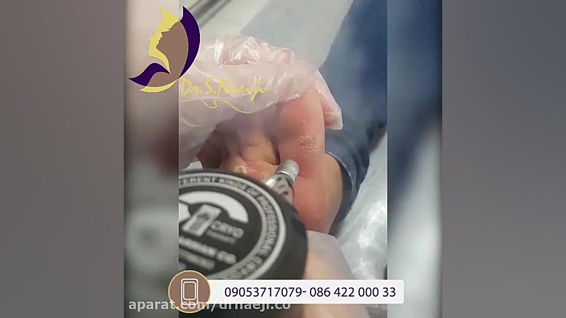کرایوتراپی پا دکتر صدیقه نائیجی | متخصص پوست و مو در قم
