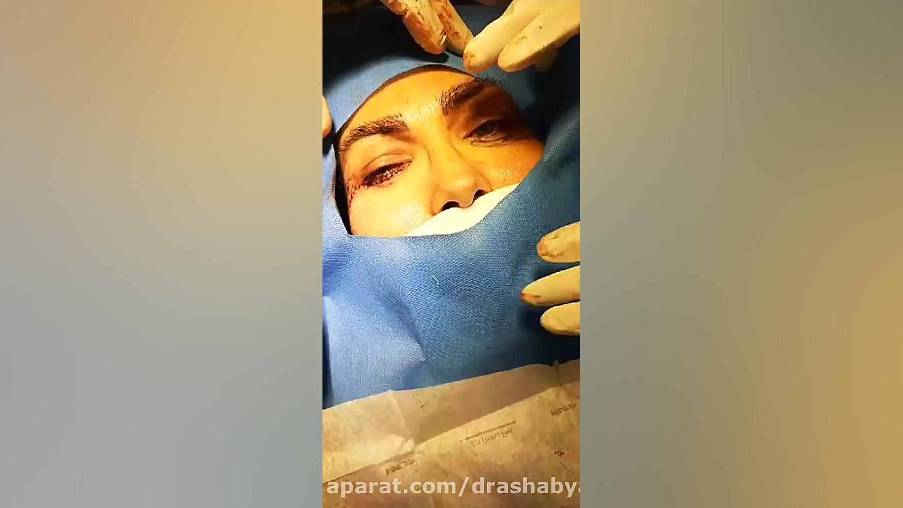 فیلم جراحی بلفاروپلاستی دکتر محمودرضا اصحاب یمین - فوق تخصص پلاستیک