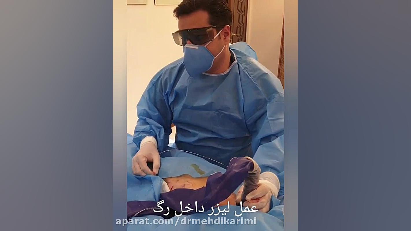 عمل همزمان لیزر داخل رگ و فلبکتومی به صورت سرپایی و بدون نیاز به بیهوشی دکتر مهدی کریمی