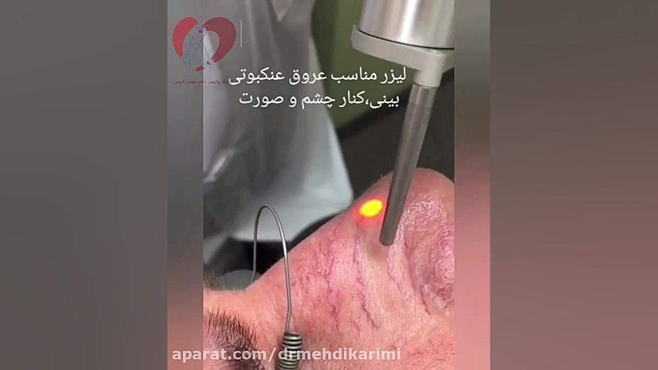 عروق واریسی ظریف کنار بینی دکتر مهدی کریمی