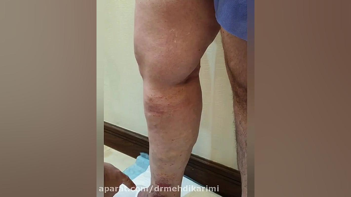 زخم واریس ناشی از واریس طنابی دکتر مهدی کریمی
