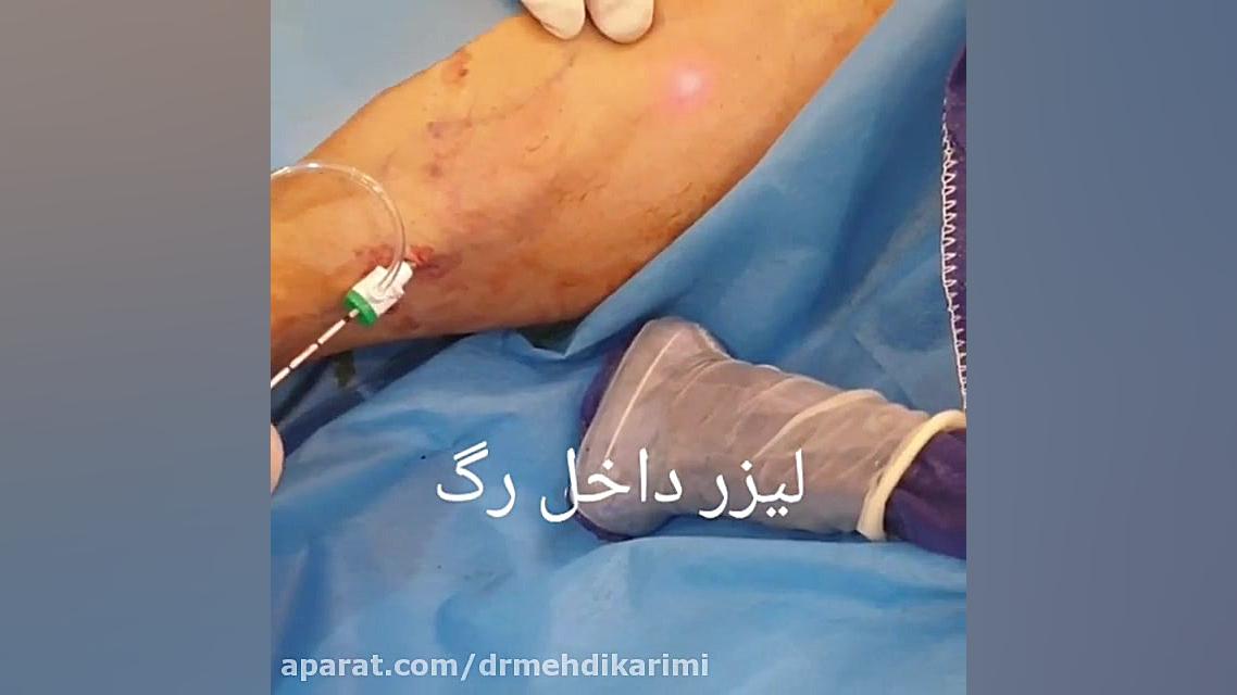 لیزر داخل عروق دکتر مهدی کریمی