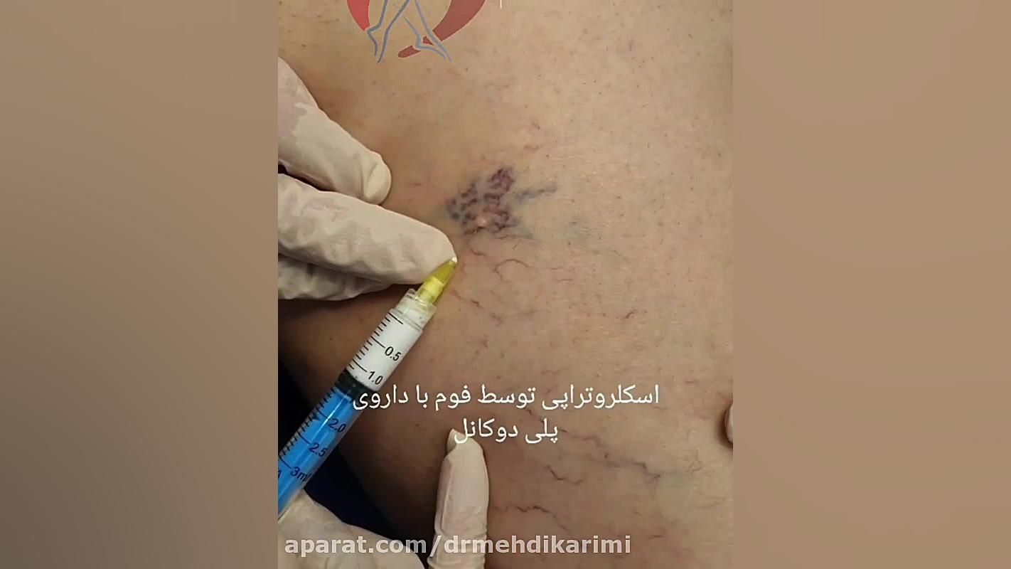 اسکلروتراپی توسط فوم با داروی پلی دو کانال دکتر مهدی کریمی