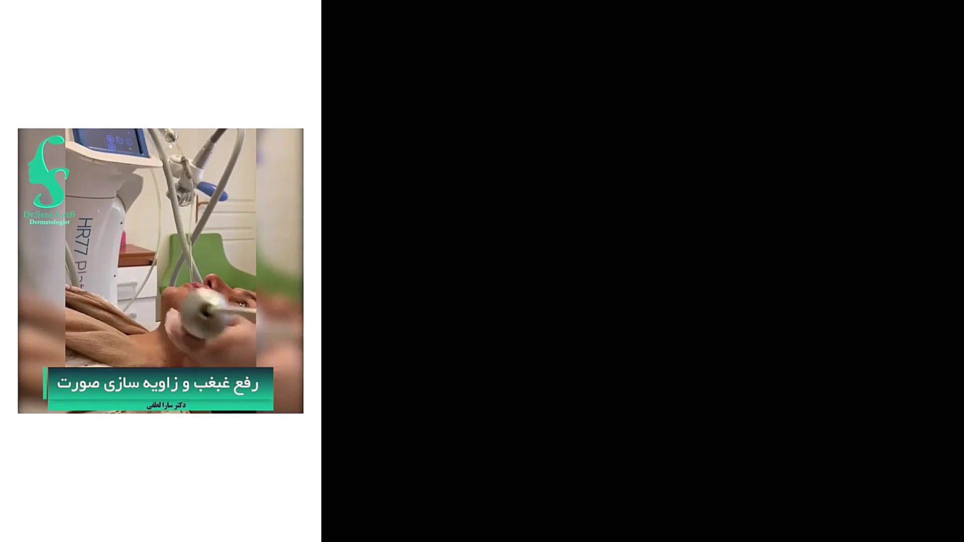 فیلم رفع چاقی غبغب با دستگاه لاغری دکتر سار ا لطفی