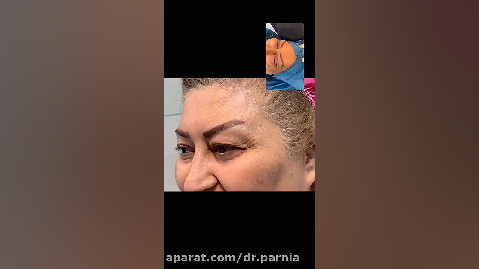 فیلم عمل بلفاروپلاستی دکتر رفیع پرنیا فوق تخصص پلاستیک