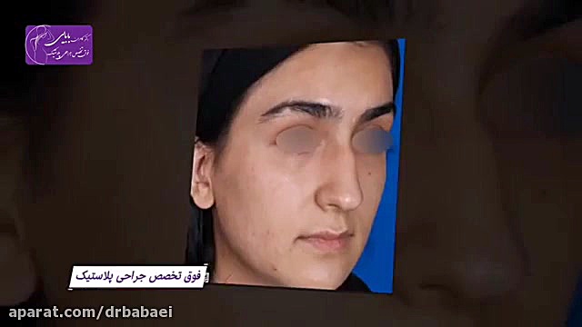 فیلم واقعی بعد از عمل بینی دکتر کامران بابایی