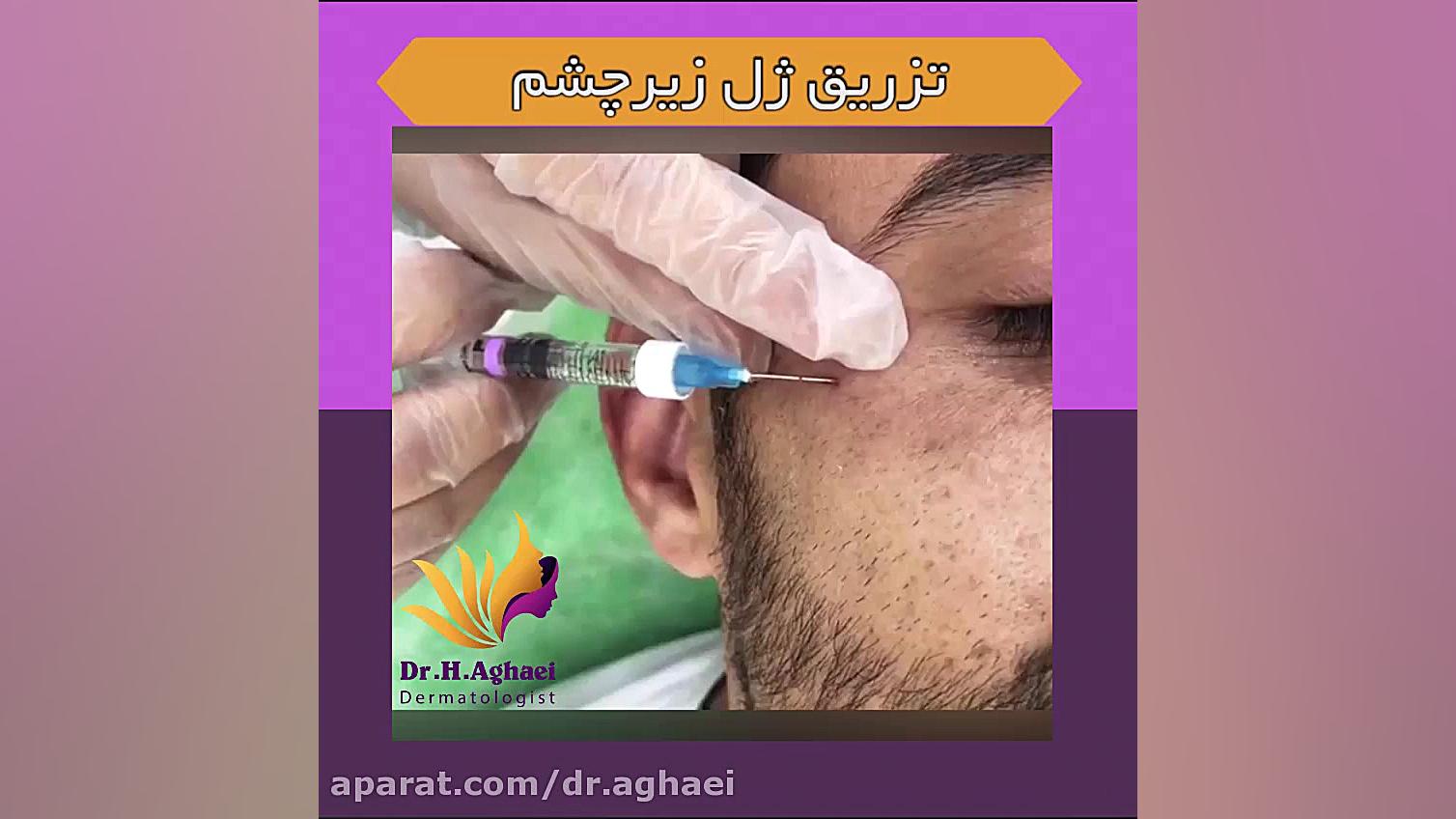 فیلم تزریق ژل زیر چشم دکتر حمیده آقایی
