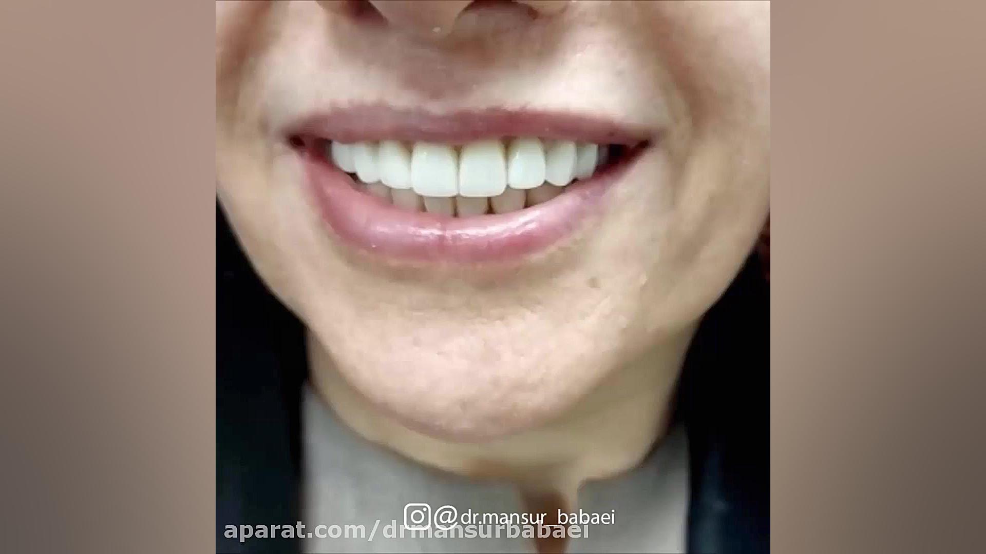 معجزه لمینیت سرامیکی دکتر منصور بابایی