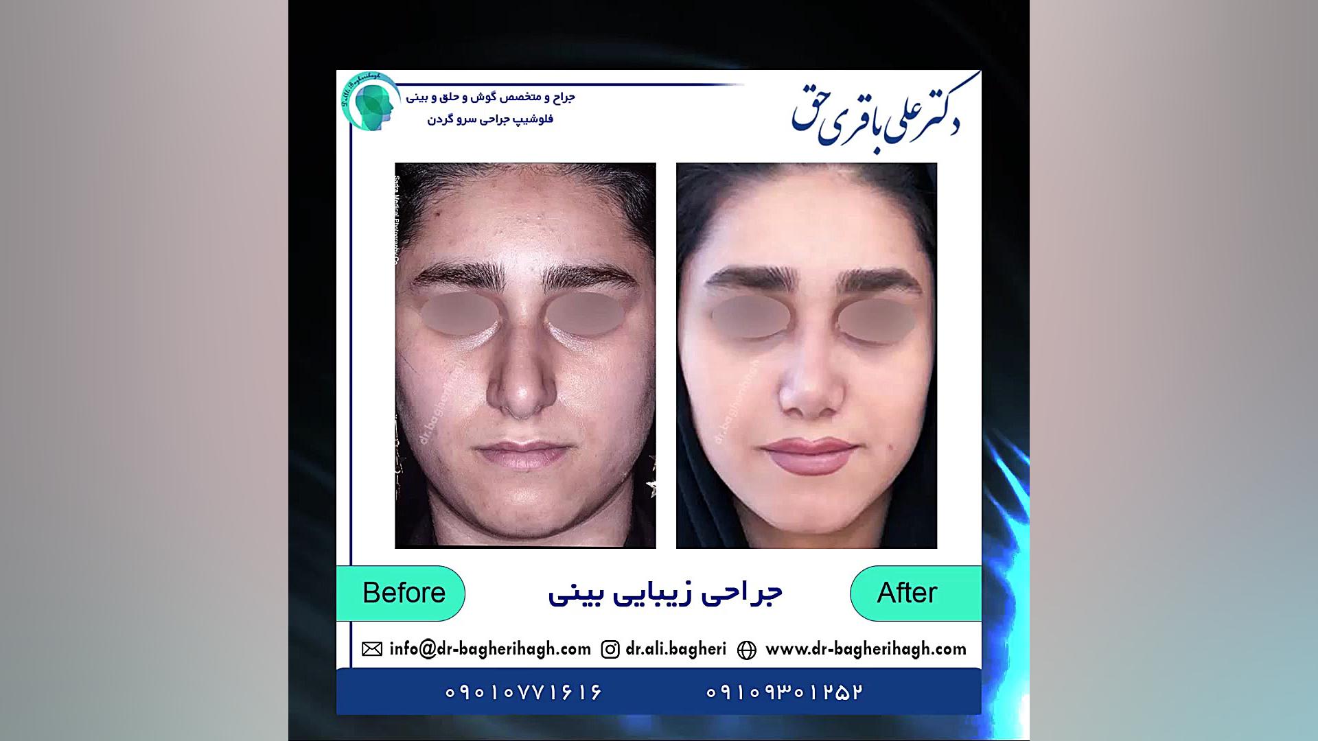 جراحی زیبایی بینی | دکتر باقری حق دکتر علی باقری حق