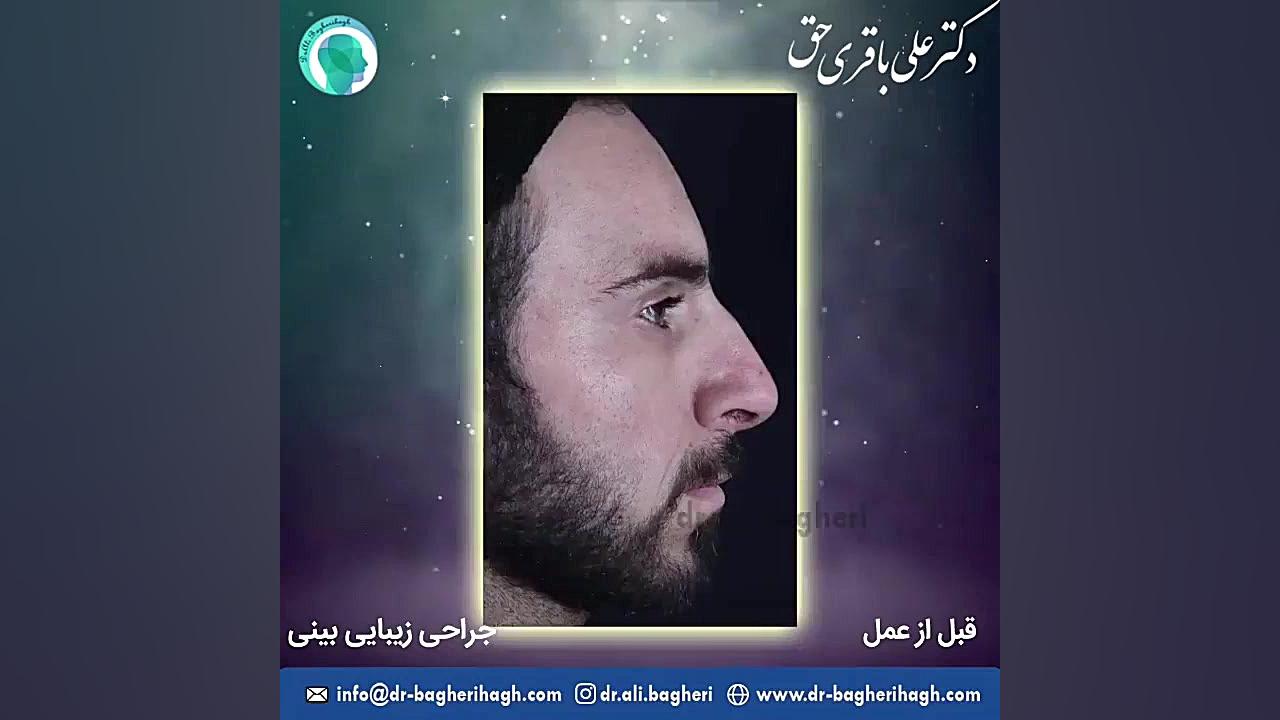 رضایت بیمار یک و سال و نیم بعد از عمل زیبایی بینی دکتر علی باقری حق