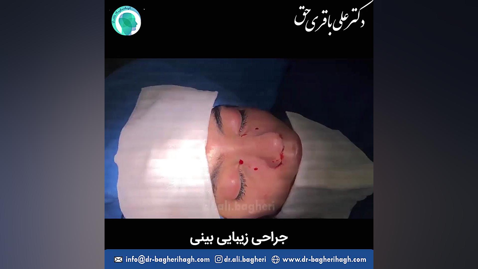 نمونه قبل و بعد از جراحی زیبایی بینی | دکتر باقری حق دکتر علی باقری حق