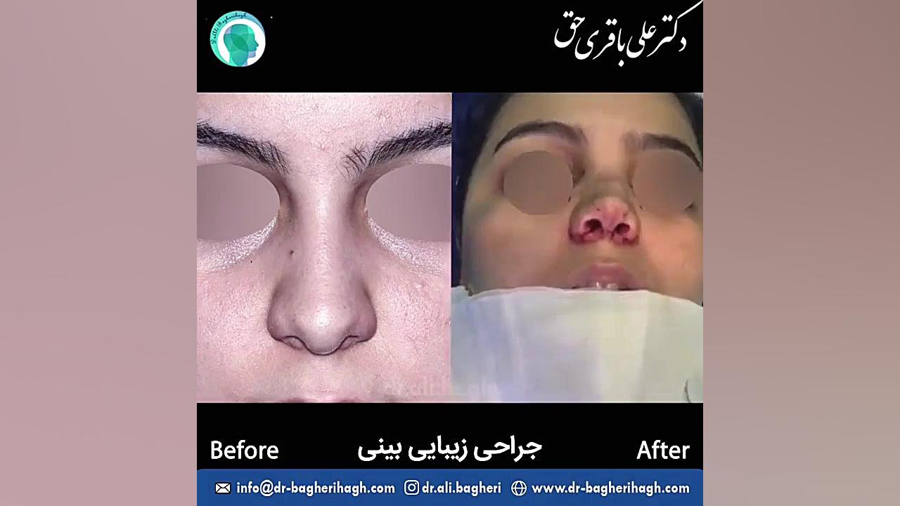 جراحی زیبایی بینی توسط دکتر علی باقری حق دکتر علی باقری حق