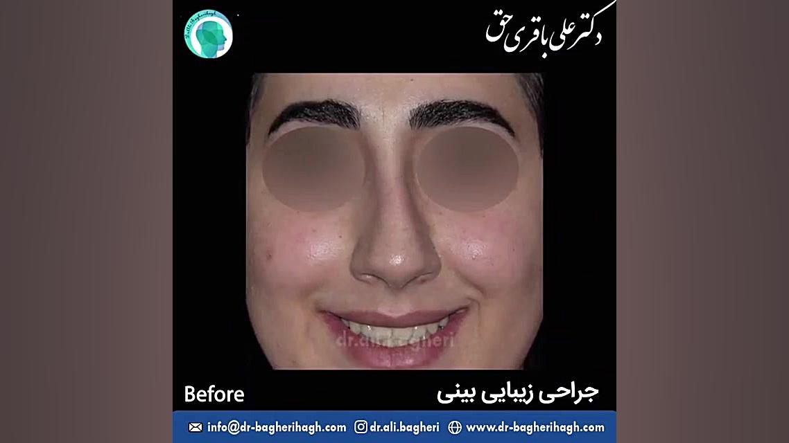 عمل زیبایی بینی | دکتر علی باقری حق دکتر علی باقری حق