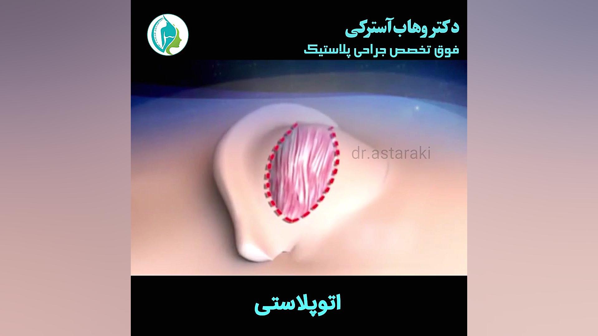 اتوپلاستی یا جراحی زیبایی گوش پر کردن دندان