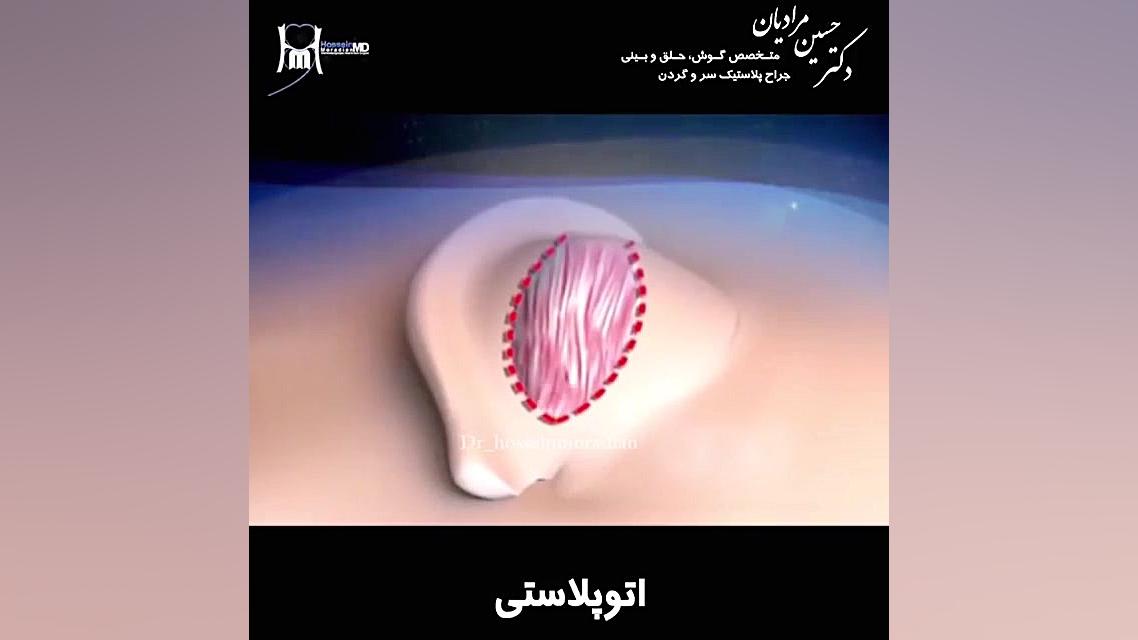 اتوپلاستی یا جراحی زیبایی گوش پوشش زخم هیدروکلوییدی