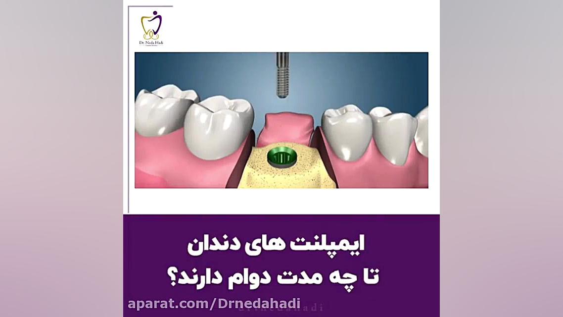 عمر ایمپلنت ها دکتر ندا هادی-دندانپزشک زیبایی