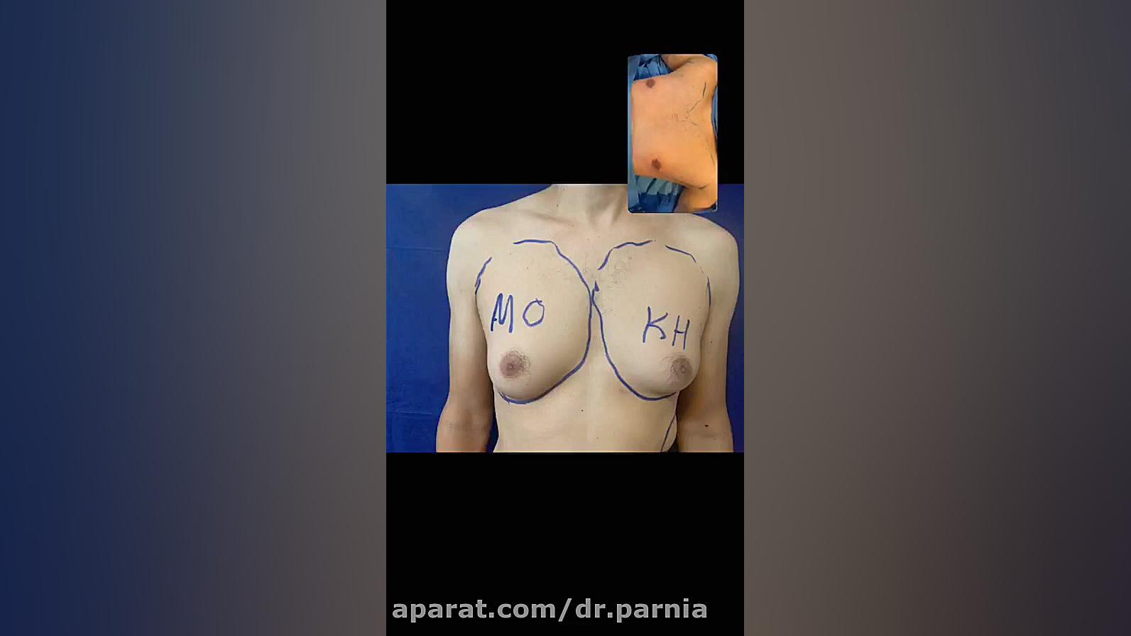 فیلم عمل ژنیکوماستی دکتر رفیع پرنیا فوق تخصص پلاستیک