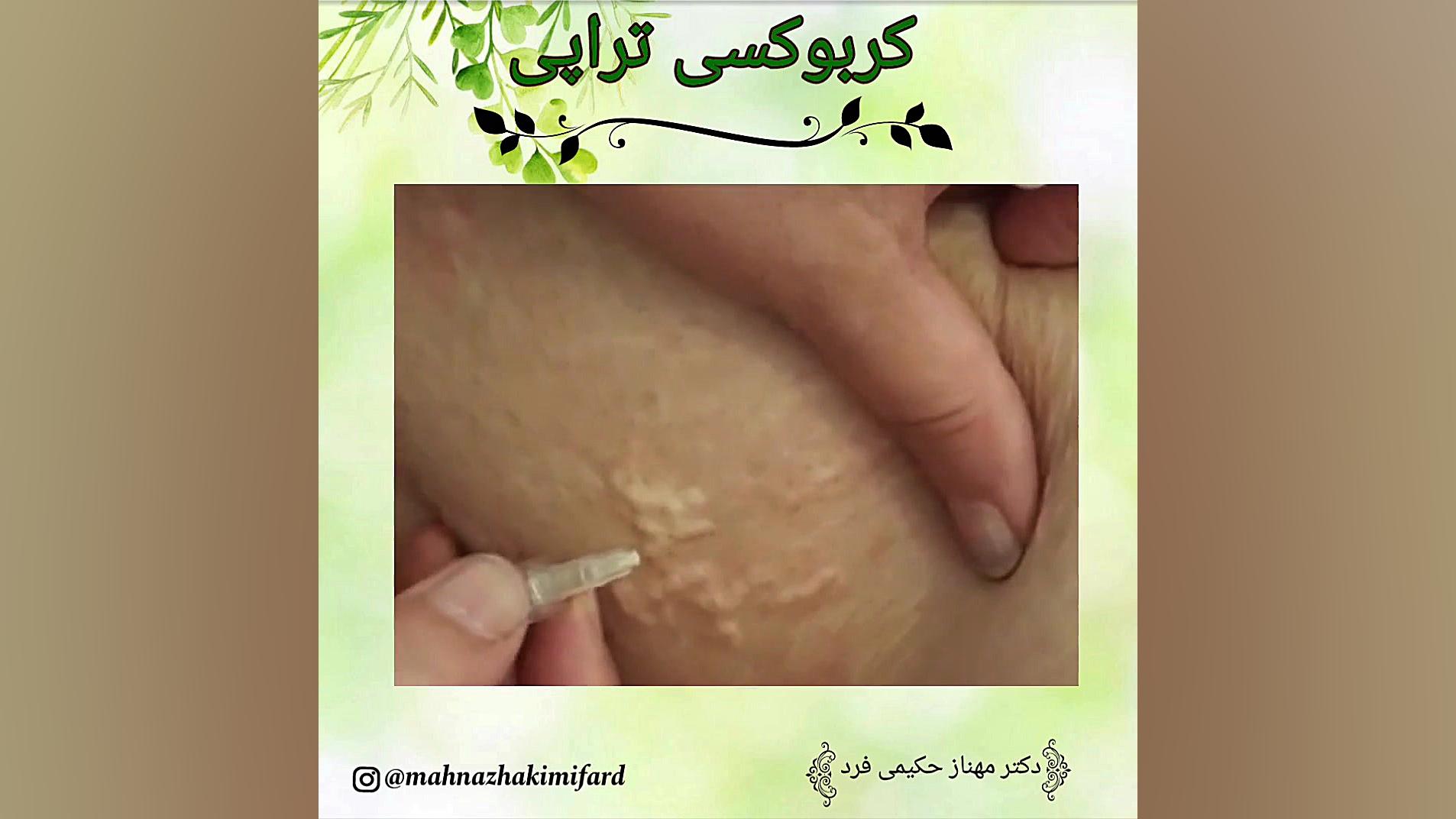 کربوکسی تراپی برای رفع ترک های شکم بعد از بارداری کلینیک دندانپزشکیایمونولوژی پیوند