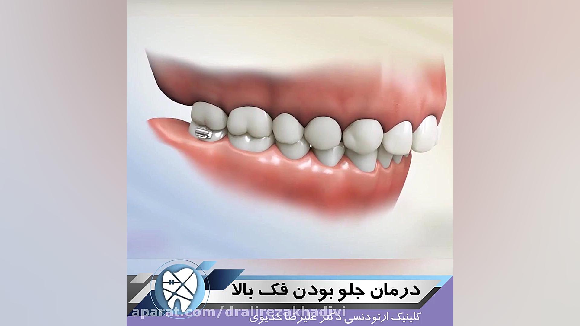 درمان جلو بودن فک بالا.متخصص ارتودنسی.دکترعلیرضاخدیوی دکتر علیرضا خدیوی