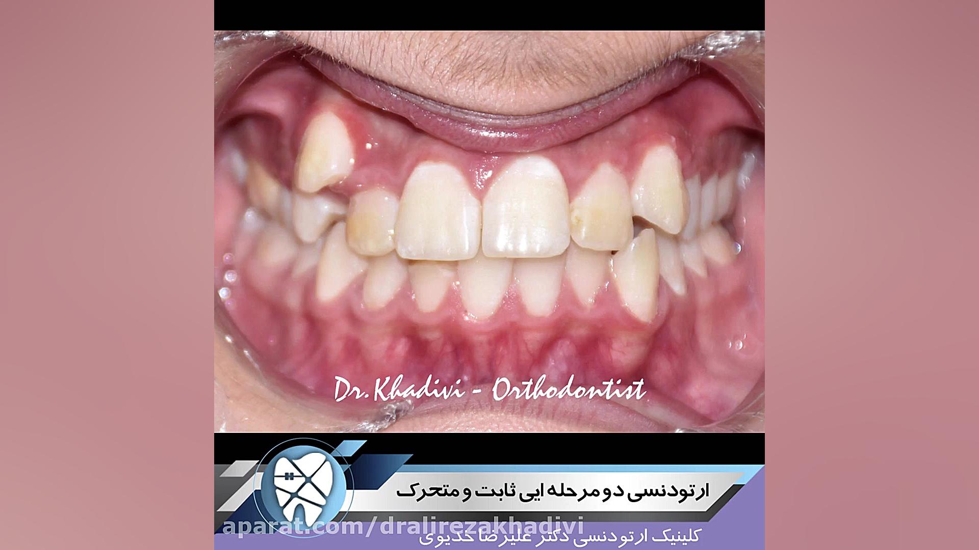 ارتودنسی دو مرحله ای ثابت و متحرک.متخصص ارتودنسی .دکترعلیرضاخدیوی دکتر علیرضا خدیوی
