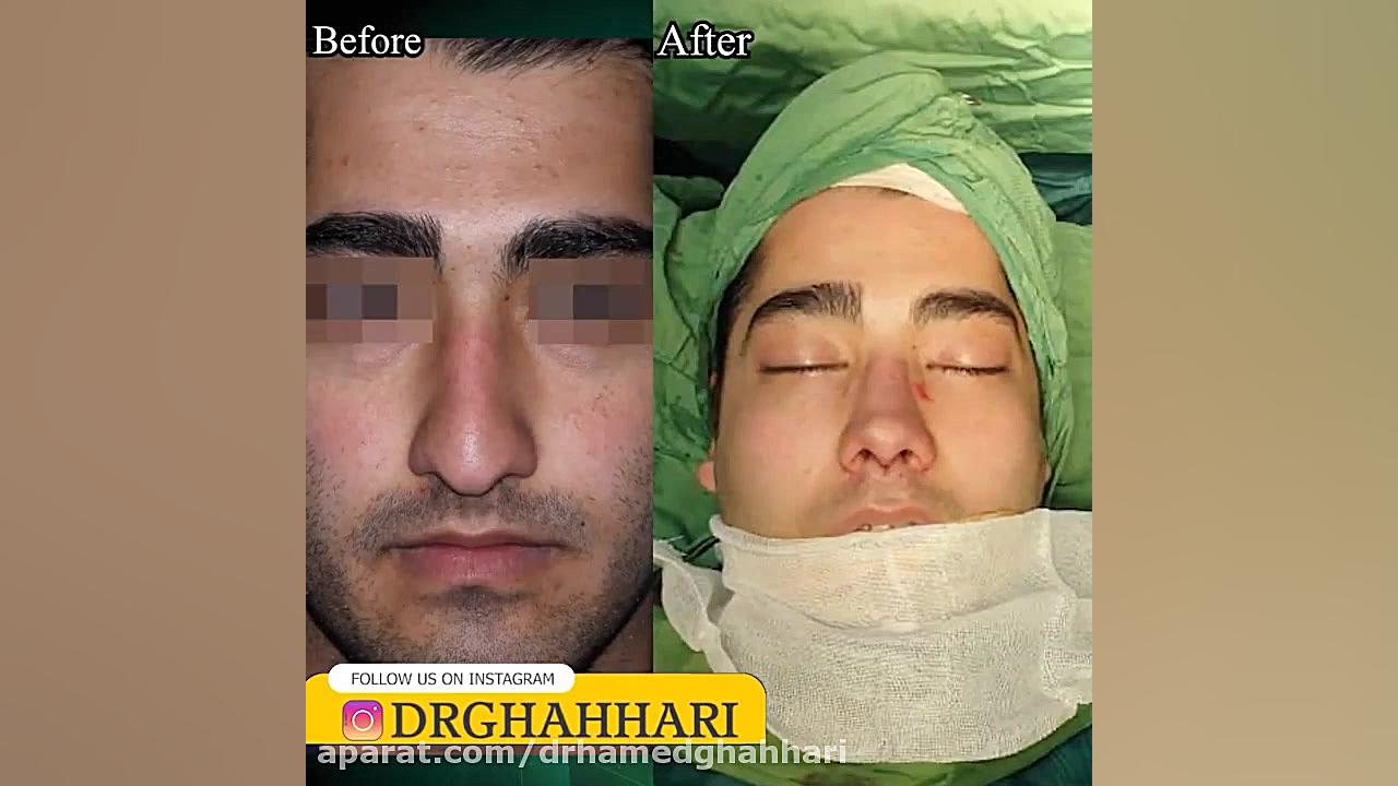 فیلم رینوپلاستی بینی گوشتی دکتر حامد محمدی قهاری