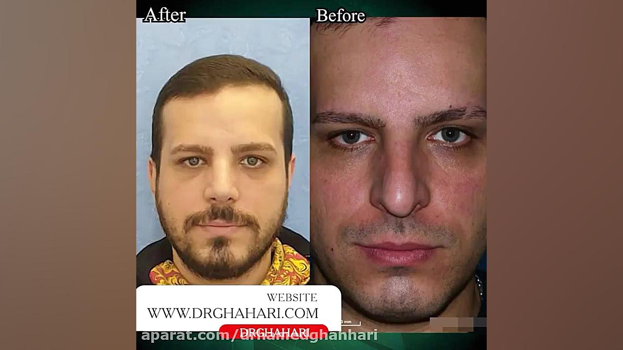 فیلم رینوپلاستی بینی بدون جراحی دکتر حامد محمدی قهاری