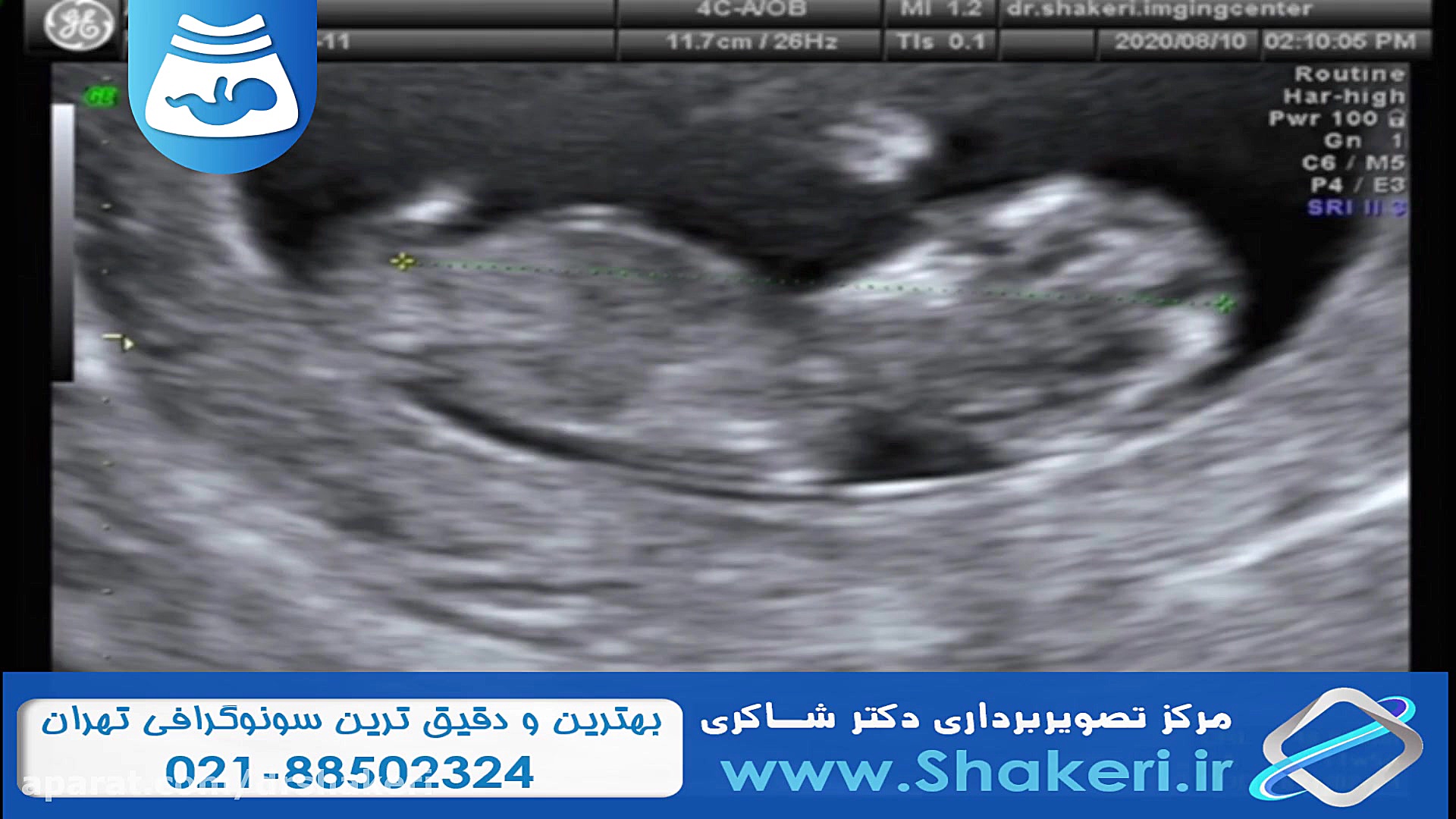 سونوگرافی nt جنین 12 هفته / مرکز تصویربرداری دکتر شاکری کاشت ریش