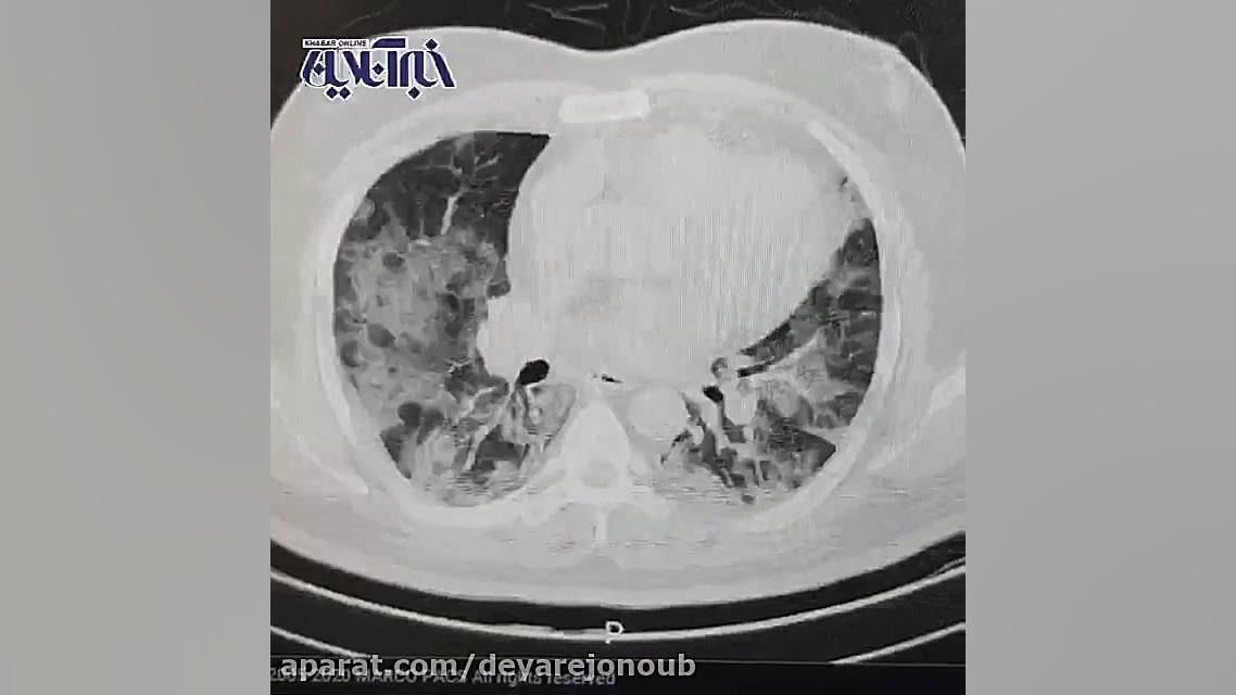سی تی اسکن ریه بیمار کرونایی لولوی بیابون