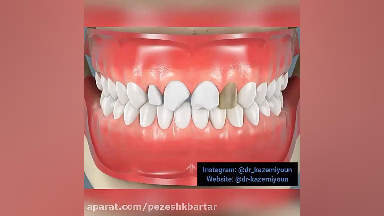 کامپوزیت ونیر بررسی اروماتاز