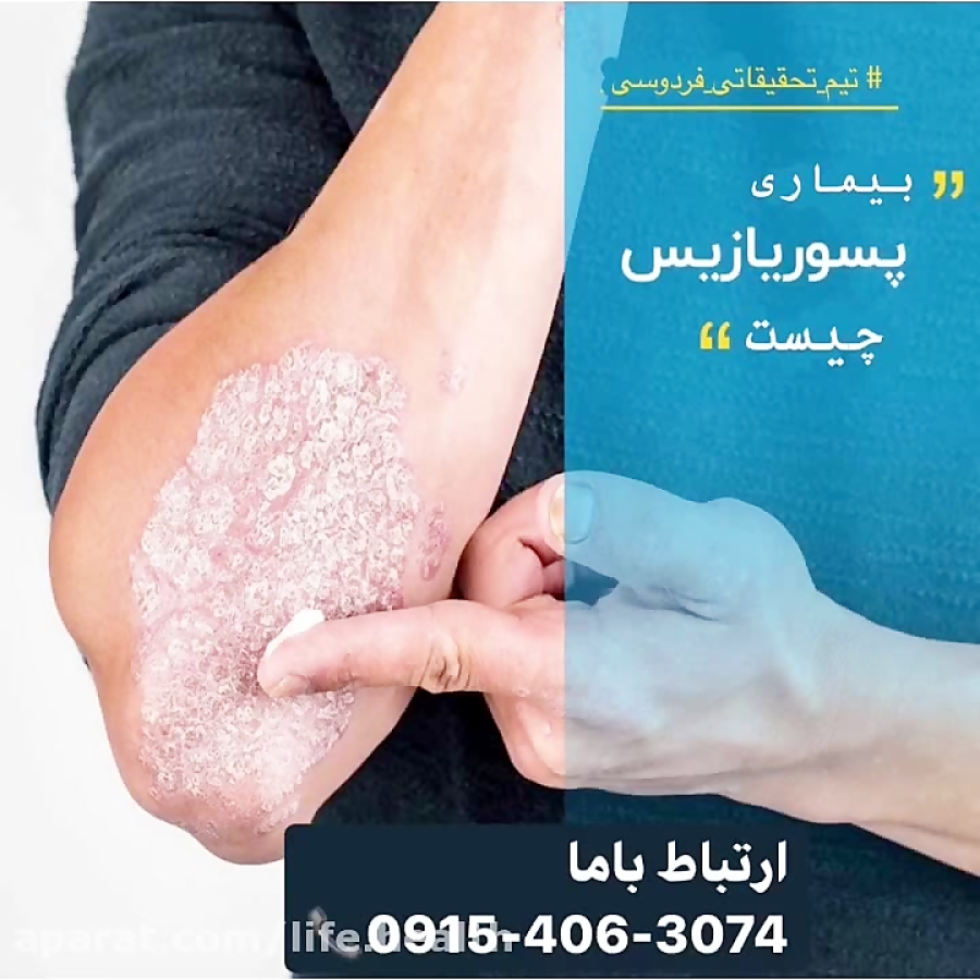 بیماری پسوریازیس
