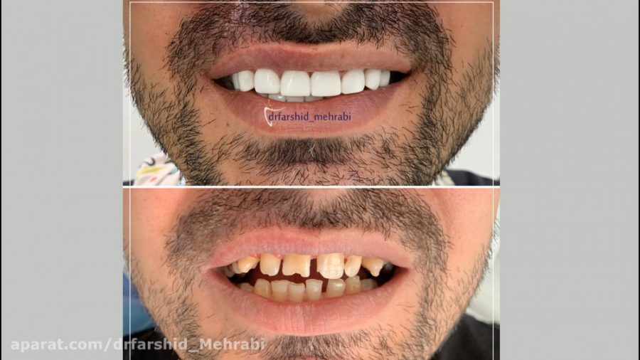 کامپوزیت دندان کاشت مو