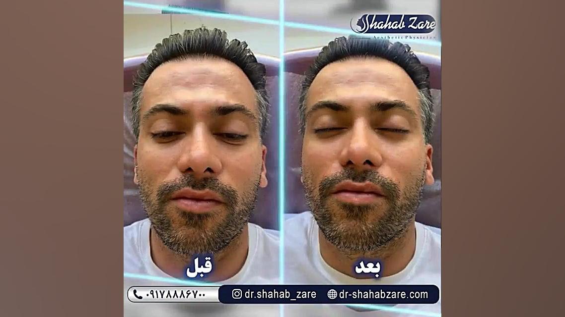 تزریق بوتاکس و یک سی سی ژل ژوویدرم ( خط خنده ) لمینت